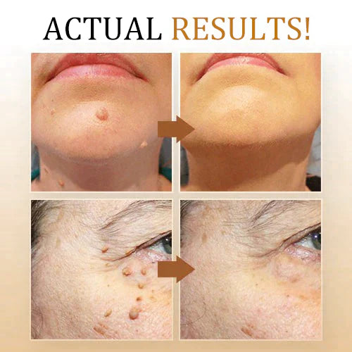SkinClear | Vortefjerner Spray – Skånsom og Effektiv Behandling