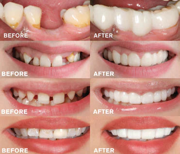 GleamSmile | Øjeblikkelig Smilforbedrende Tandprotese